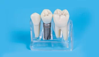 How Dental Implants Can Give You Back Your Smile